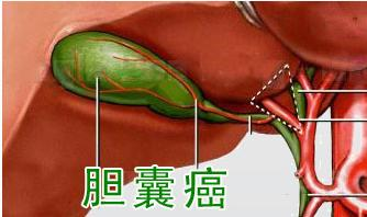 广州市御和堂中医治疗胆囊癌效果好不好