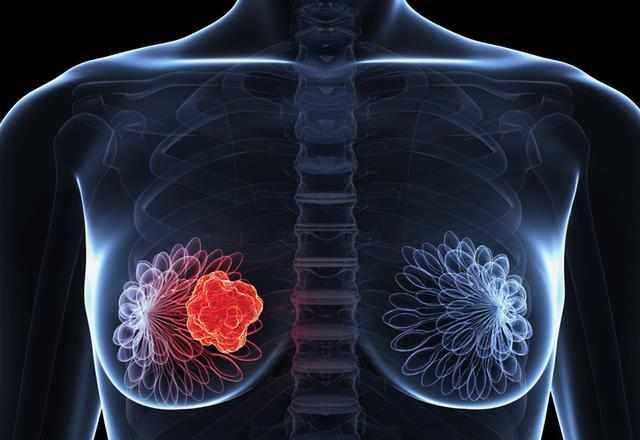 广州肿瘤老中医黄俊：乳腺癌化疗后，这些问题需注意！