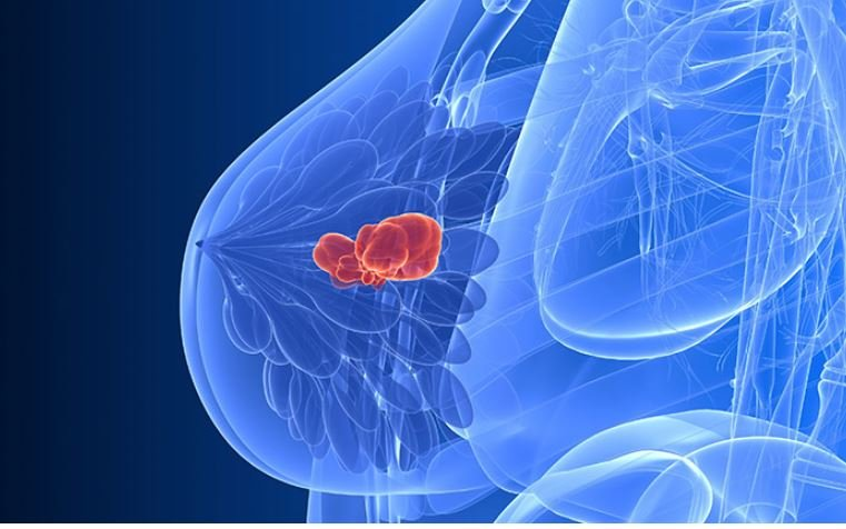 广州肿瘤老中医黄俊：乳腺癌化疗后，这些问题需注意！