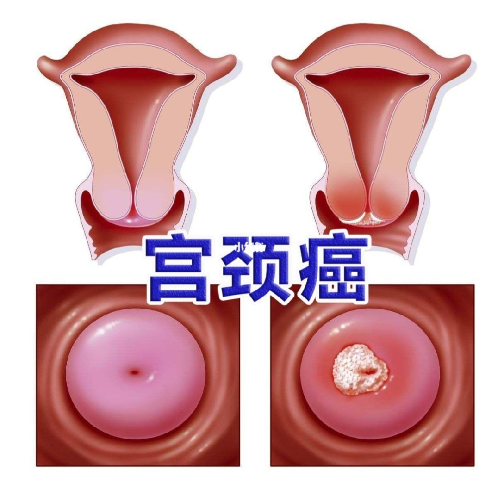 广州肿瘤医师黄俊告诉你宫颈癌对于女性的危害有多大