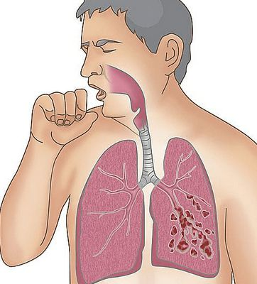 黄俊肿瘤医师:肺癌患者只有3个月生存期,家属代诊寻求中医帮助