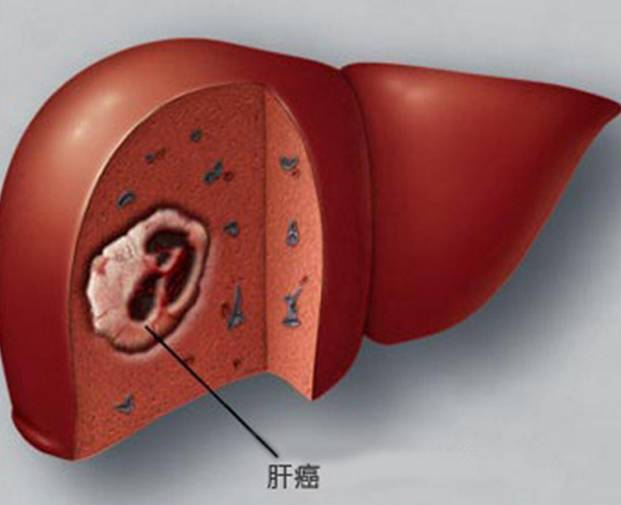 中医对于肝癌是如何辩证治疗的?黄俊医师是这样说的!