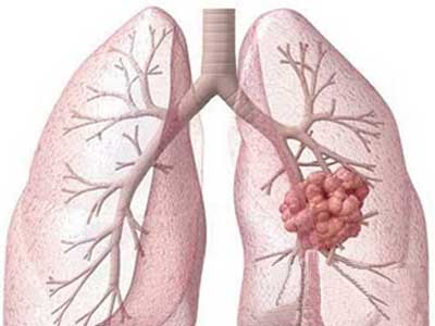 中医对于肺部肿瘤是如何辩证治疗的？听听医师黄俊怎么说