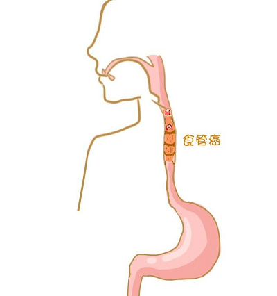 肿瘤医师张忠民:中医治疗食道癌,切记半途而废