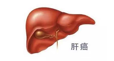 广州中医肿瘤医师:为何肝癌是世界发病率第五,死亡率第三高的癌症