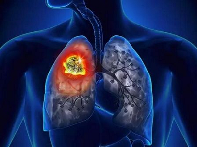广州中医肿瘤医师:当心经久不愈的咳嗽,可能是肺癌