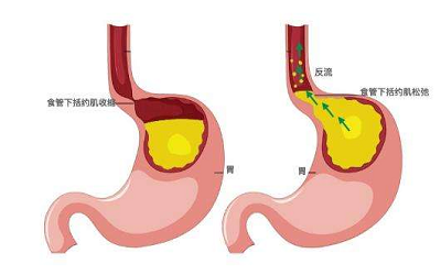 广州肿瘤科医馆|香港又一明星因胃癌不幸逝世,这4个因素会诱发胃癌
