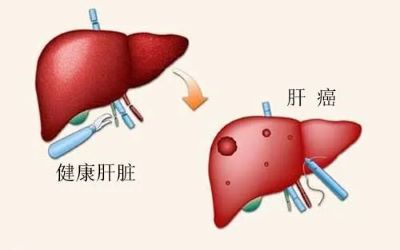 广州中医肿瘤医馆排名|引发肝癌的这些原因你都了解吗