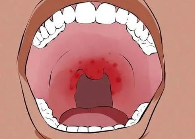 广州中医治疗口腔癌有名的老中医:口腔癌的这几种症状表现你了解吗