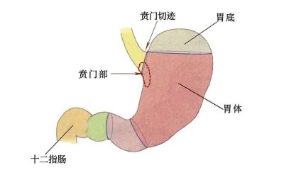 广州中医肿瘤医师:了解贲门癌早期症状,中医才能更好的治疗