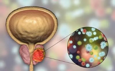 广州治疗睾丸癌权威中医医师:睾丸癌是什么?为什么乳制品会增加患睾丸癌的风险