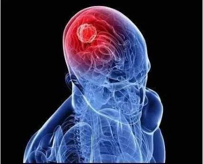 广州中医肿瘤医师:有哪些症状表现是儿童神经胶质瘤