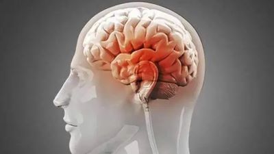 广州肿瘤老中医:脑胶质瘤是怎么回事?脑瘤因该如何预防呢