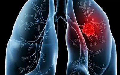广州中医肿瘤医师:防止肺癌比较好的方法是什么