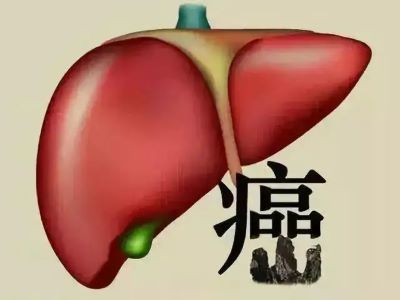 广州中医肿瘤专家:牢记这三类人最容易患上肝癌