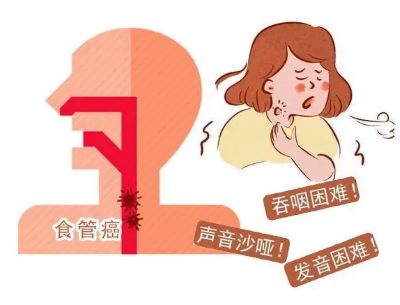 广州中医肿瘤专家排名|普及食管癌的诊断方法以及治疗方法