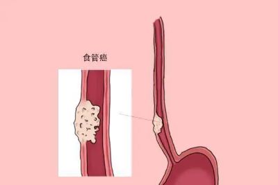 广州治疗食管癌老中医:什么样的饮食方式可能会导致食管癌呢