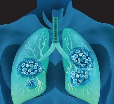 肺癌人群为何不断增多原因是什么?广州中医医师张忠民看完你就明白了