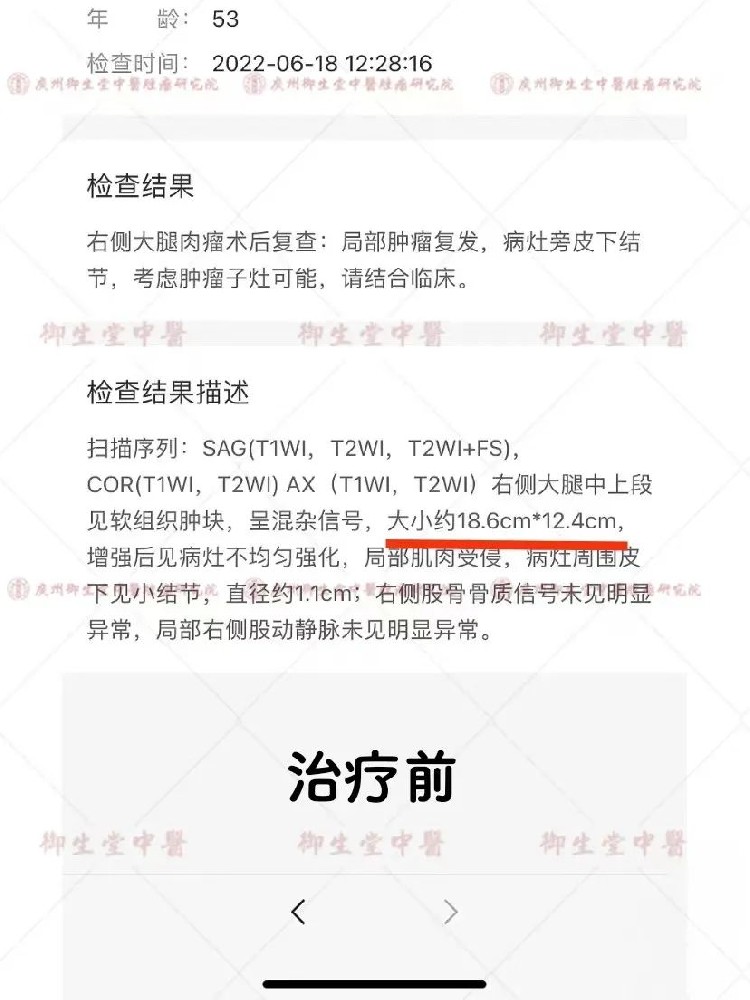 御和堂案例|大腿肉瘤术后复发 中药治疗缩瘤止痛