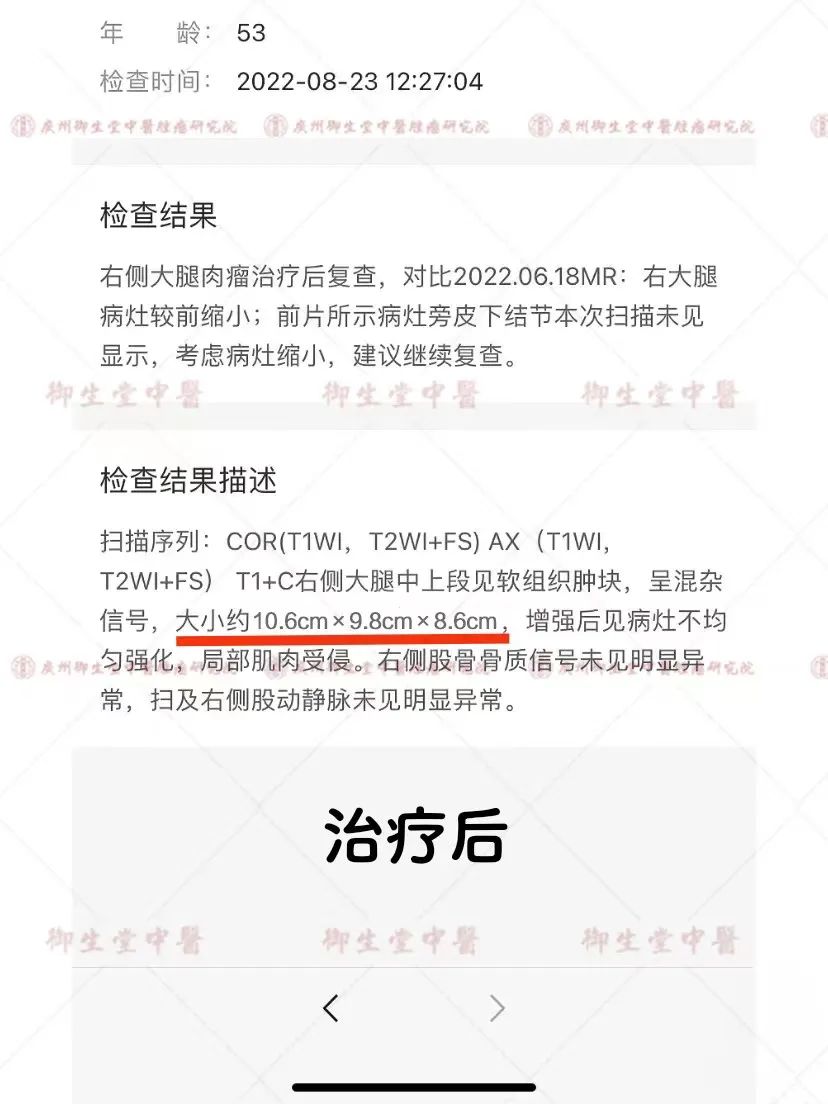 御和堂案例|大腿肉瘤术后复发 中药治疗缩瘤止痛
