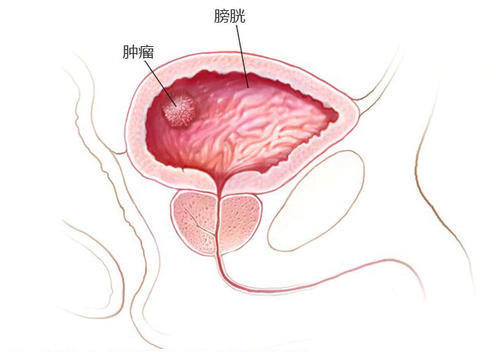 膀胱癌是怎么引起的？赶紧了解一下